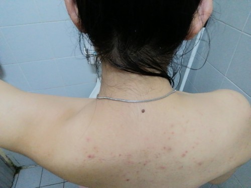 ผื่นที่หลัง