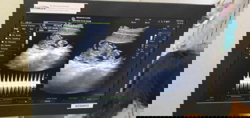 14+3 ลูกสะอึก