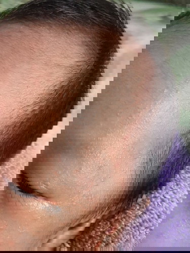 rashes