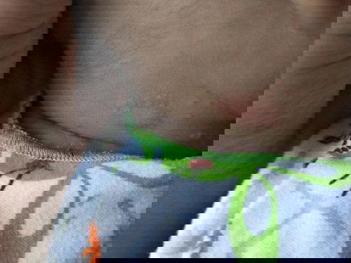 ada yang pernah? obatnya apa?