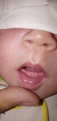 benjolan kecil putih