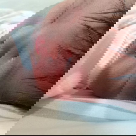 Bakit po kaya ganito skin ni baby. She is 1 day old.