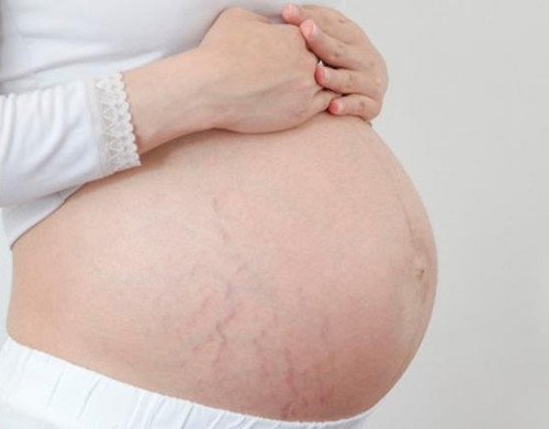 Apakah bunda menggunakan Stretchmark Cream?