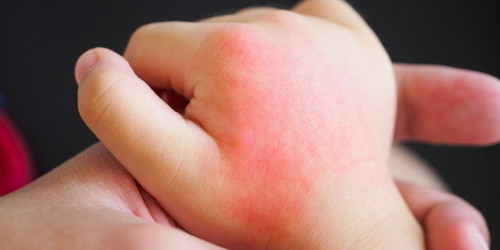 What is the first thing you do when you find that your child has a rash/condition?