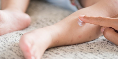 Has you child ever gotten chicken pox?