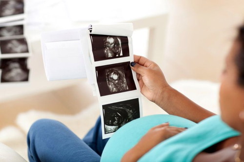 Adakah anda menjalani pemeriksaan kecacatan kelahiran untuk bayi semasa hamil?