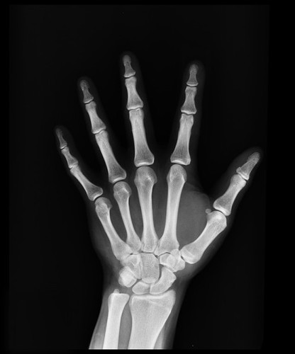 Okay lang bang ipa-xray ang isang toddler?
