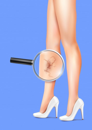 Nagkaroon ka ba ng varicose veins nitong nagbuntis ka?