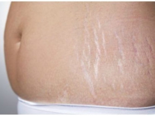 When did your stretch marks appear?