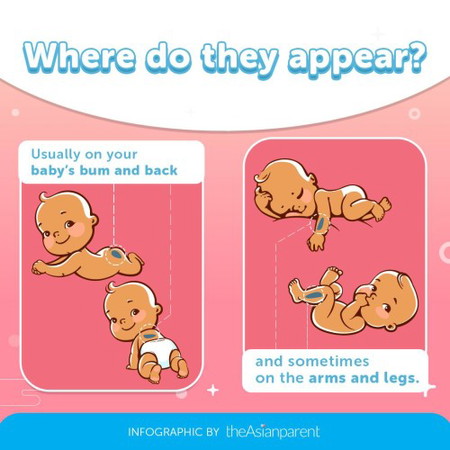 Saan ang Mongolian blue spot (blue/green na balat) ni baby?