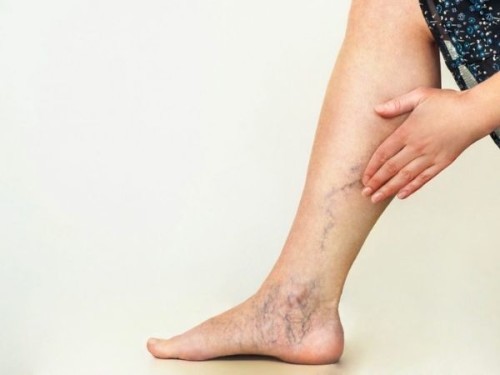 Varicose Veins & Haemorrhoids