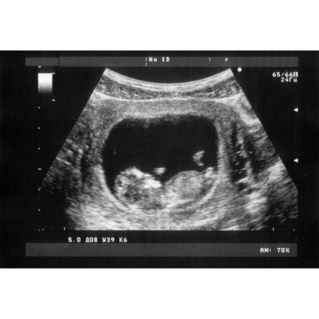 Subchorionic Bleeding During Pregnancy