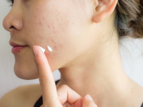 Did you suffer from any skin issues during pregnancy?