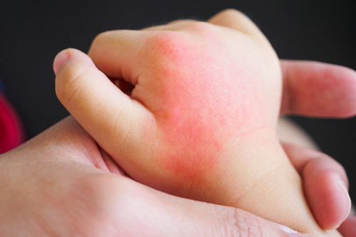 Nakaranas ba ng rashes si baby nu’ng bagong panganak siya?