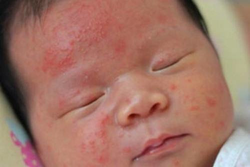 Adakah anak anda mempunyai kulit yang sensitif semenjak lahir?
