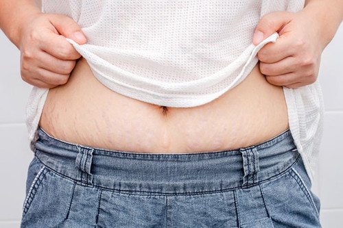 Losyen stretchmarks. Bilakah waktu ibu mula amalkan pemakaiannya?