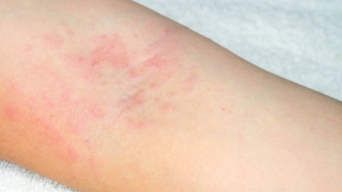 Effective ba ang dahon ng bayabas para sa eczema?