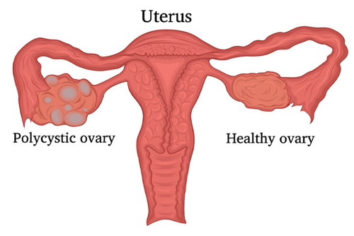 Baca sini : <a href='https://my.theasianparent.com/sindrom-pcos' target='_blank' >https://my.theasianparent.com/sindrom-pcos</a>