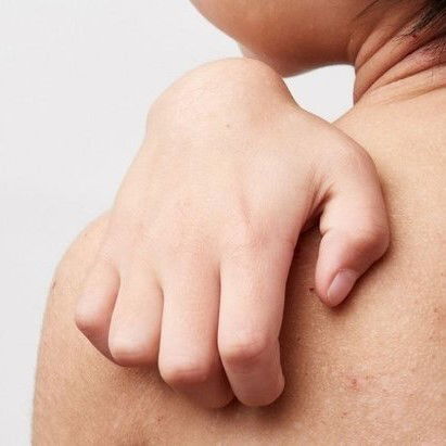 Atopic Dermatitis in kids