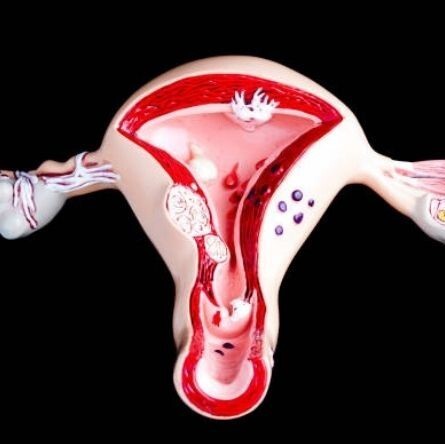 What Is Septate Uterus?