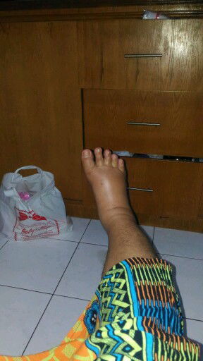 kaki mulai bengkak