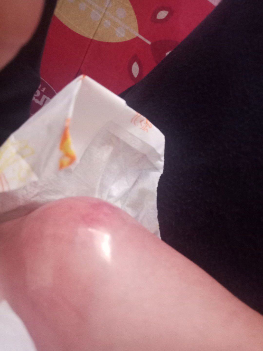 Pano po mawala yung pamamaga ng hita ni baby?