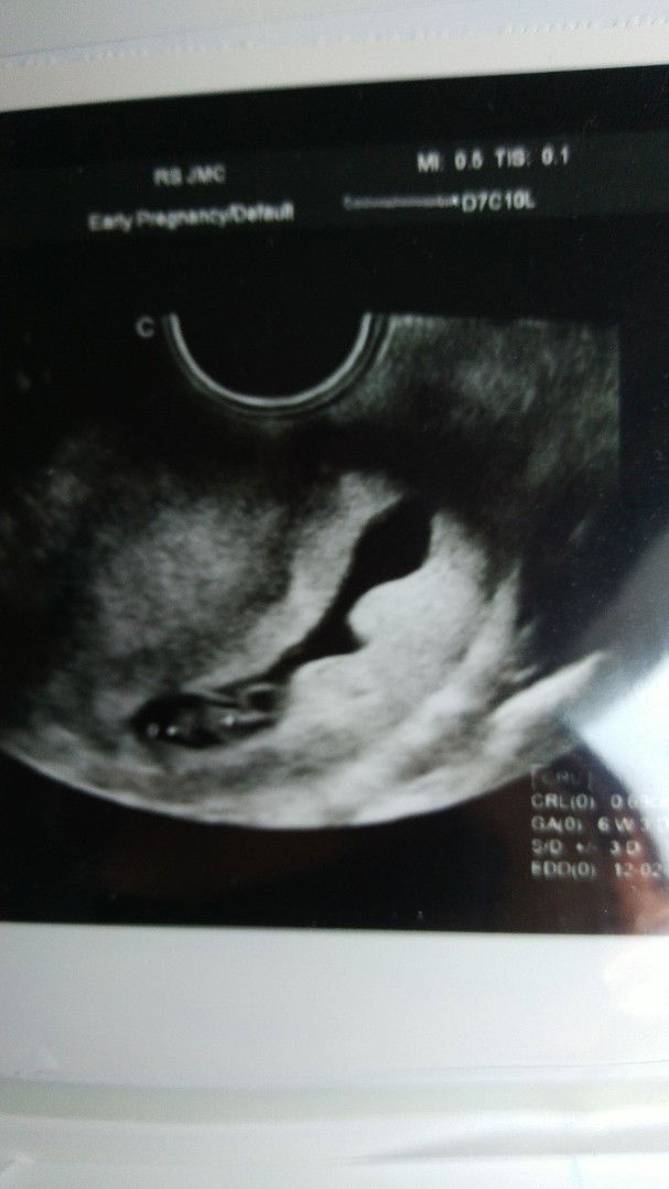 kantong kehamilan lonjong tidak beraturan