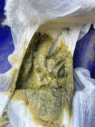 อุจจาระสีเทา