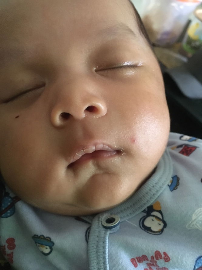 Bibir bayi kering