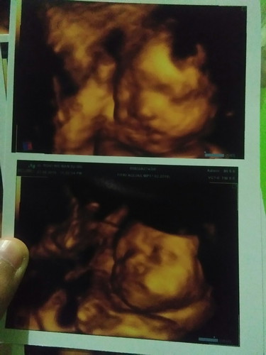 usg 28 weeks