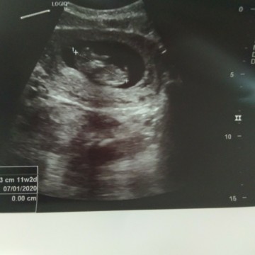11w 2d สามารถรู้เพศได้ยังค่ะ ตื่นเต้นมากค่ะ?