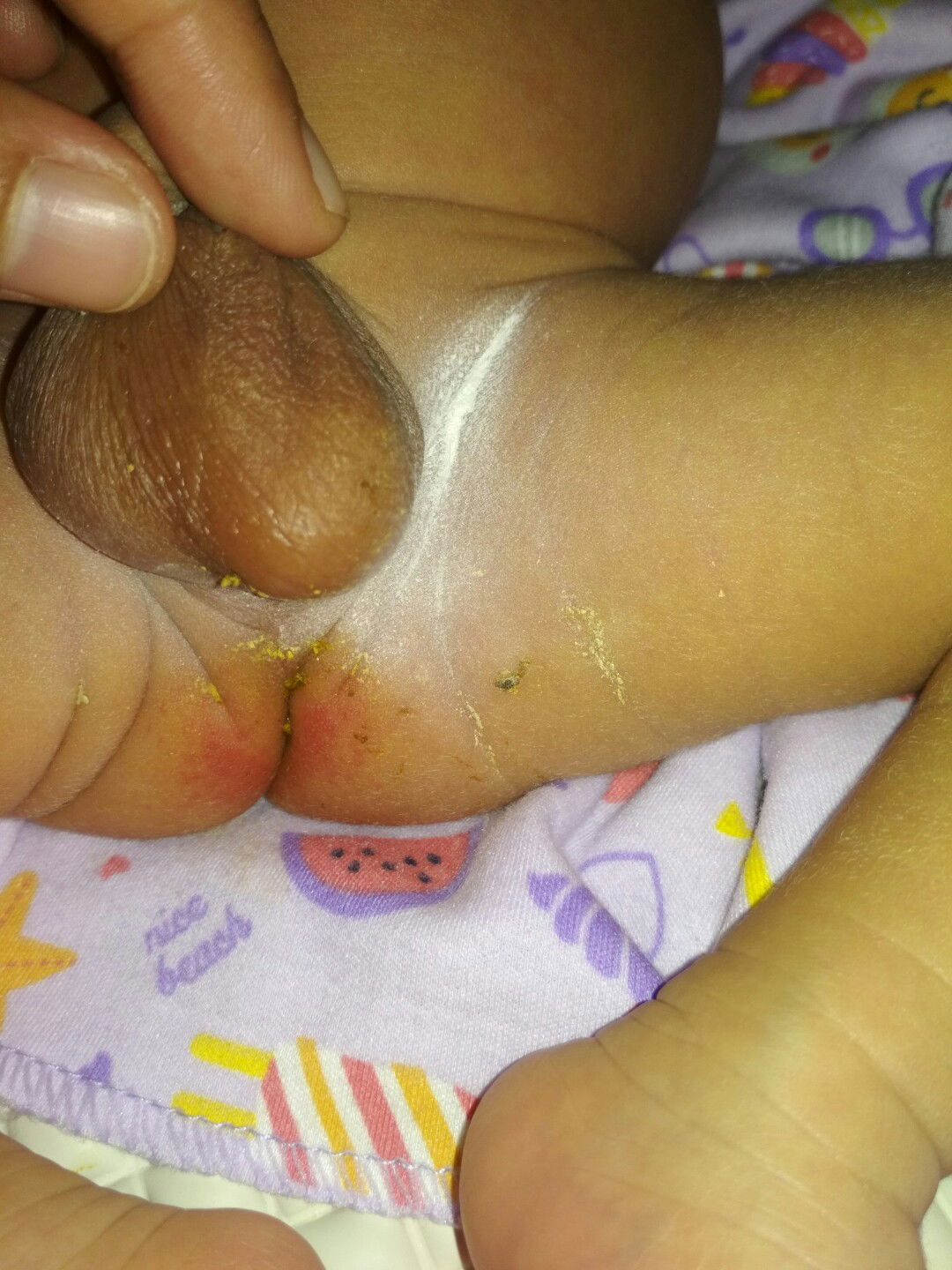 Merah Pada Pantat Bayi