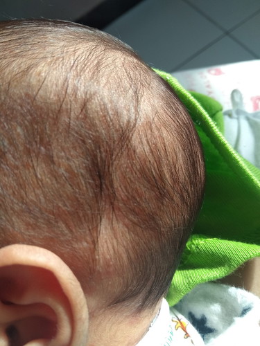 benjolan dekat telinga