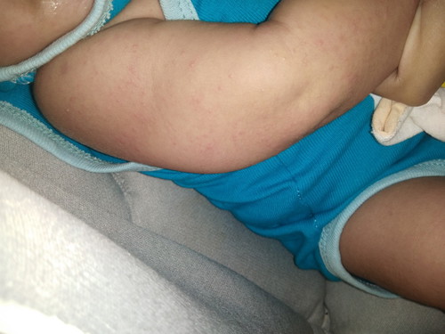 allergy