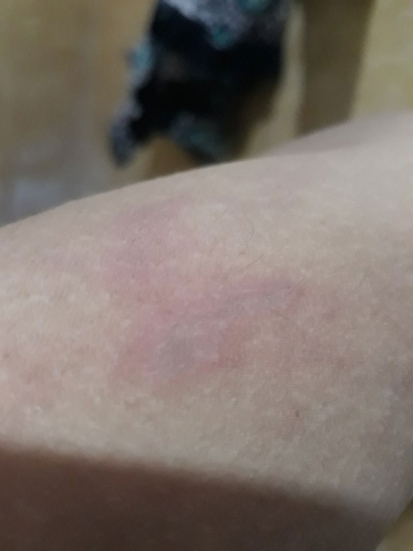 Kulit Melepuh di TM3