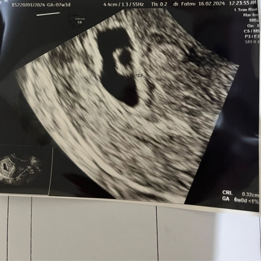 Hamil udah 7week tapi belum ada detak jantung