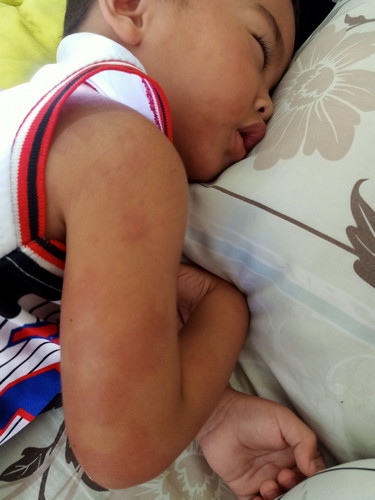 ลูกเป็นผื่น