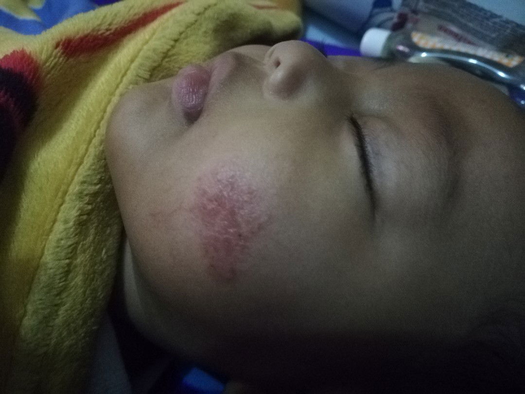 Kembalikan Pipi Mulus Nya Anakku ?