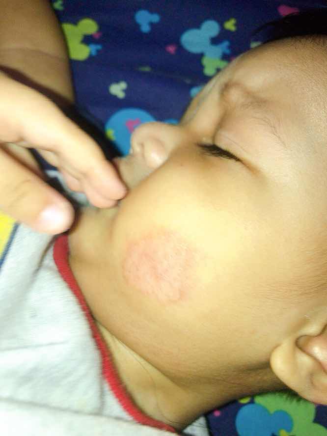 Iritasi kulit karna asi