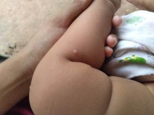 ตุ่มใสๆแบบนี้อีสุกอีใสรึป่าวค่ะ