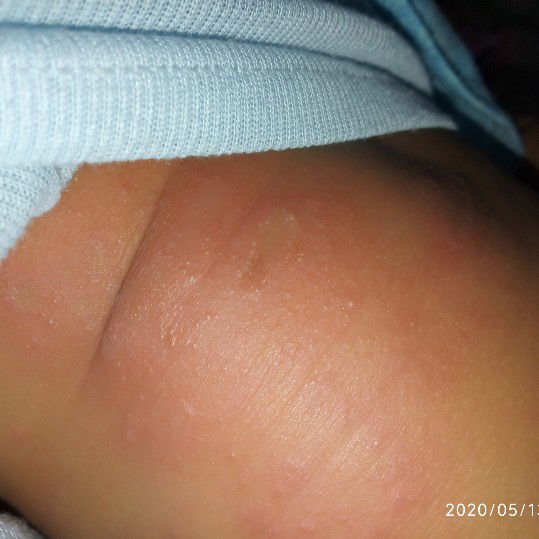 seperti ruam tp lebih para krn berair