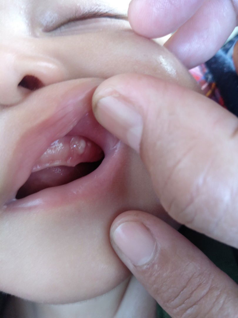 Sariawan atau bukan?