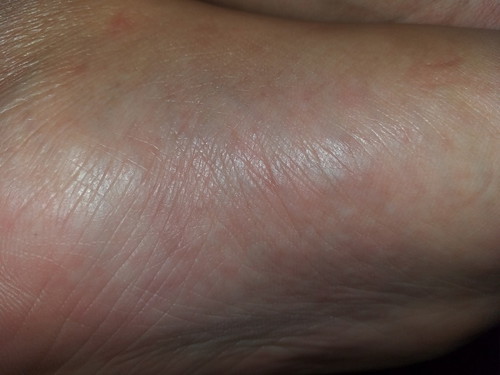 cara mengobati gatal