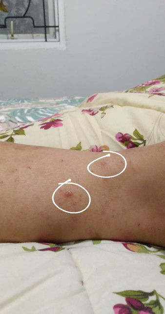 Kena cacar di minggu 26