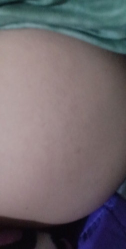 Stretchmarks.