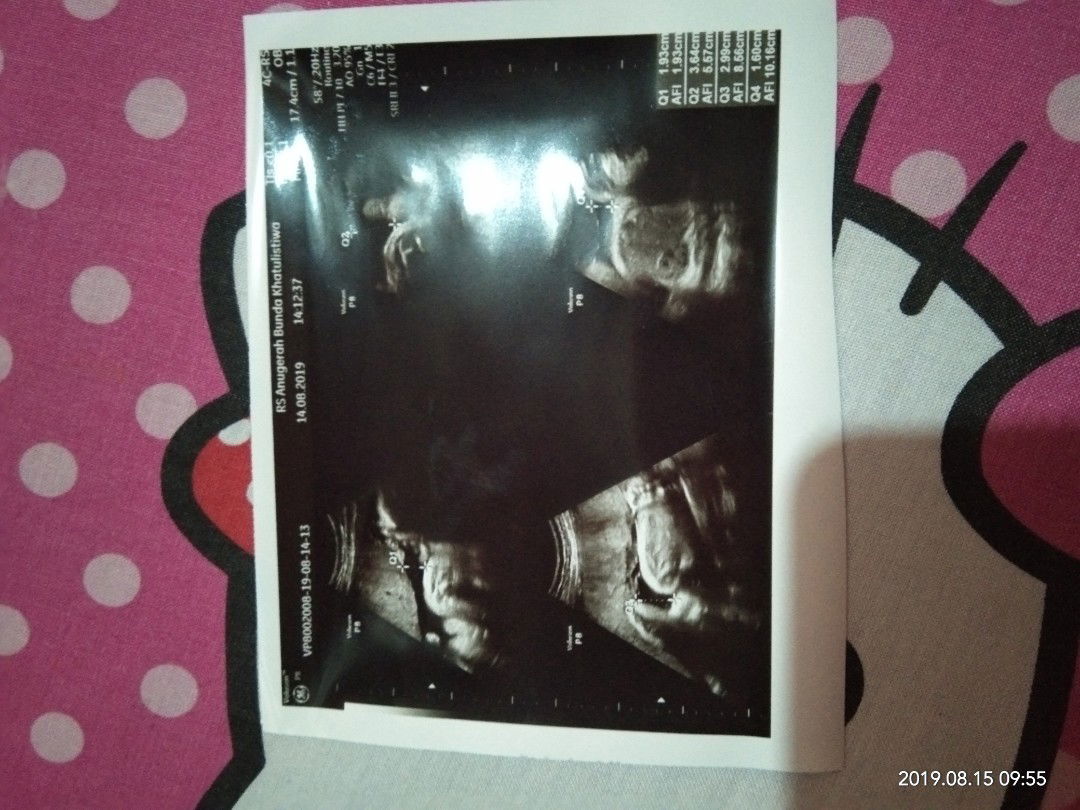 Detak jantung janin cepat