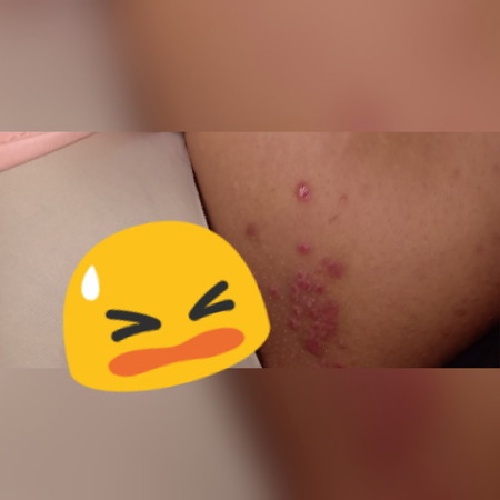 rashes/kati