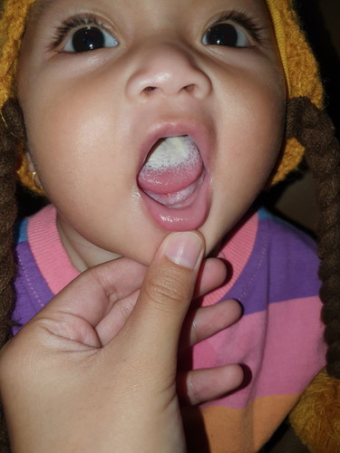 Lidah putih bagi bayi