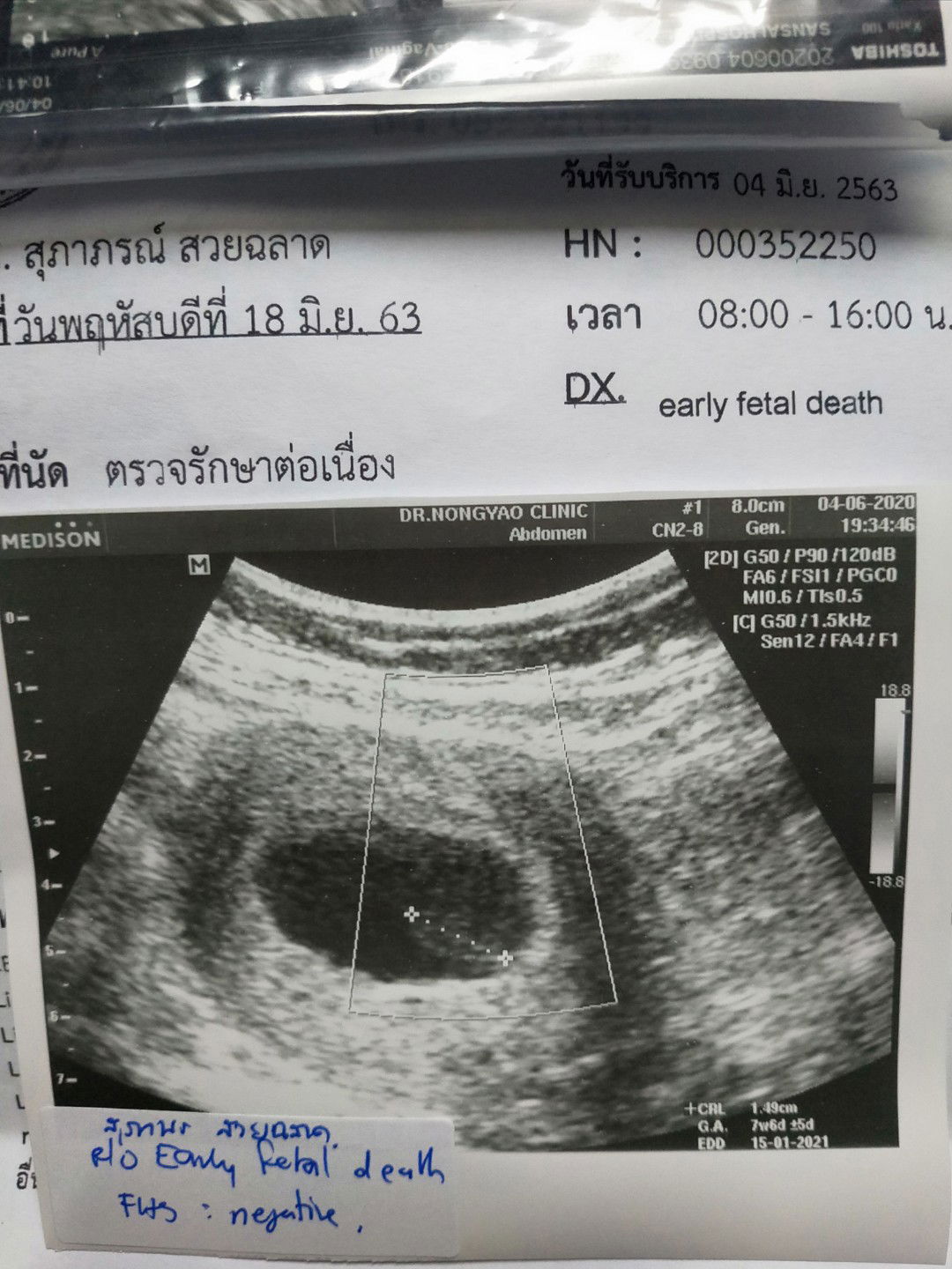 น้องหัวใจไม่เต้น