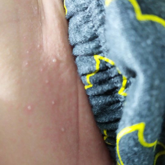 ini ruam atau apa ya mom